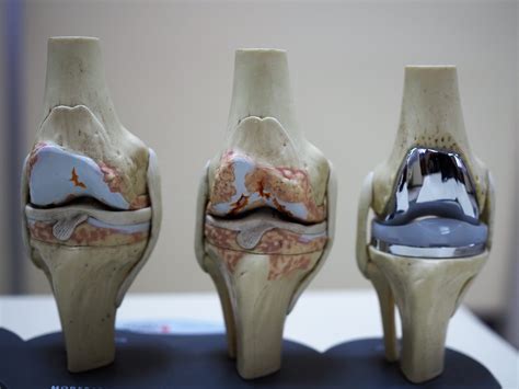 what are fake knees made of
